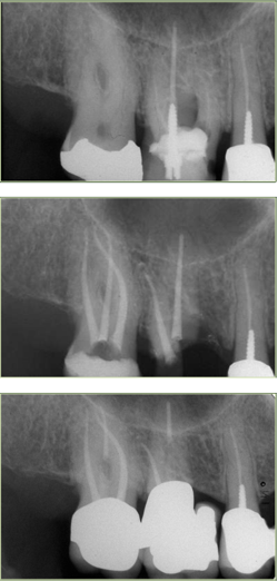Endodonzia